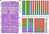 Histological examination of tumor samples correlates with cell types captur