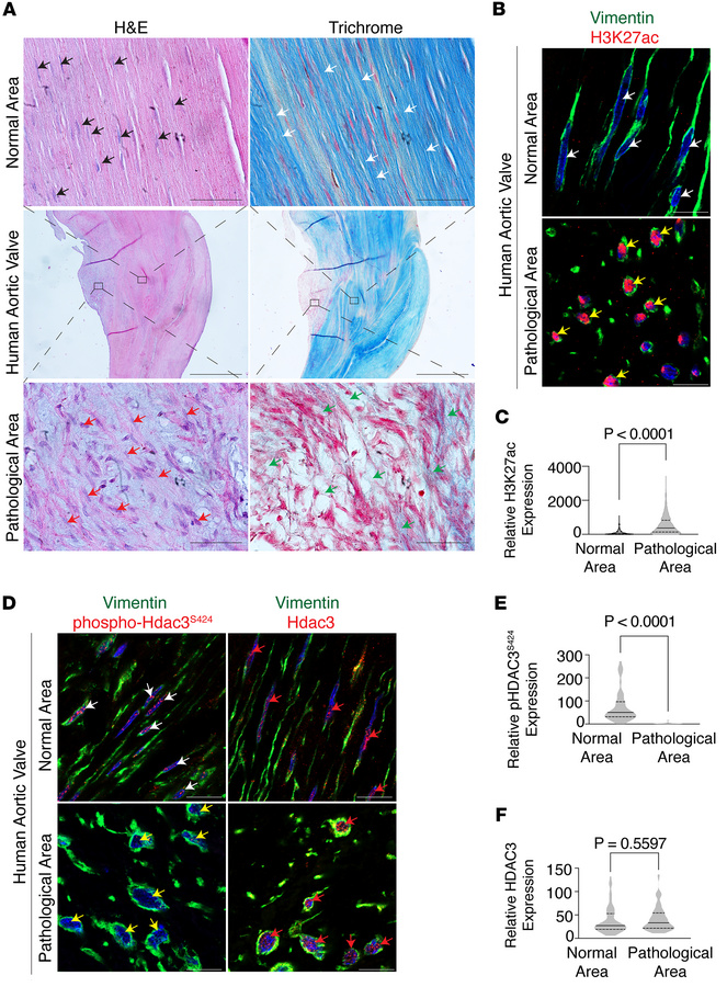 Histological and epigenetic alterations in human aortic valve stenosis.
...