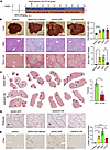 Preventing SRSF3 degradation reduces HCC.