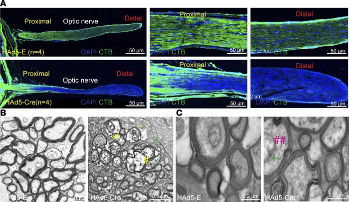 Decreased microtubules and neurofilament are associated with axonal tran...