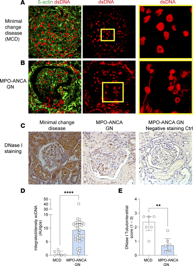 Enhanced ecDNA deposition and reduced DNase I expression in kidney biops...