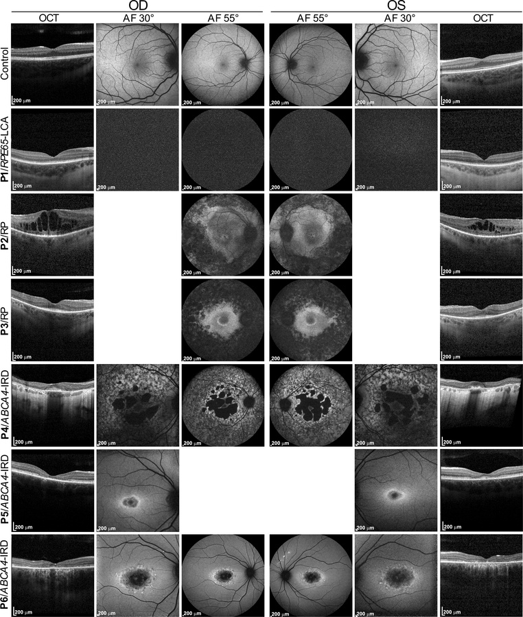 Clinical phenotype of patients.
The top panel shows optical coherence to...