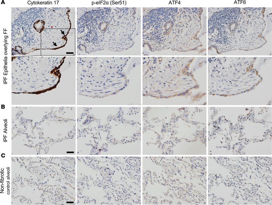 IPF epithelia overlying fibroblastic foci (FF) express stress markers.
R...
