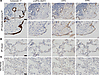 IPF epithelia overlying fibroblastic foci (FF) express stress markers.