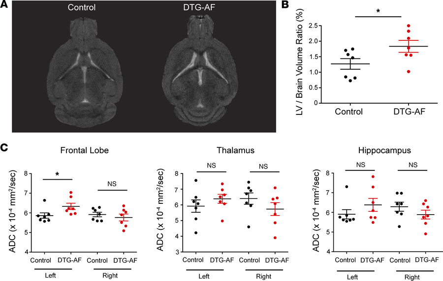 Ventriculomegaly and increased ADC in left frontal lobe of DTG-AF mice o...