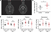 Ventriculomegaly and increased ADC in left frontal lobe of DTG-AF mice on b