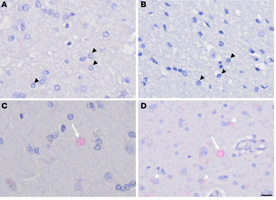Representative IHC staining of HPgV in control and PD.
(A and B) Subcort...