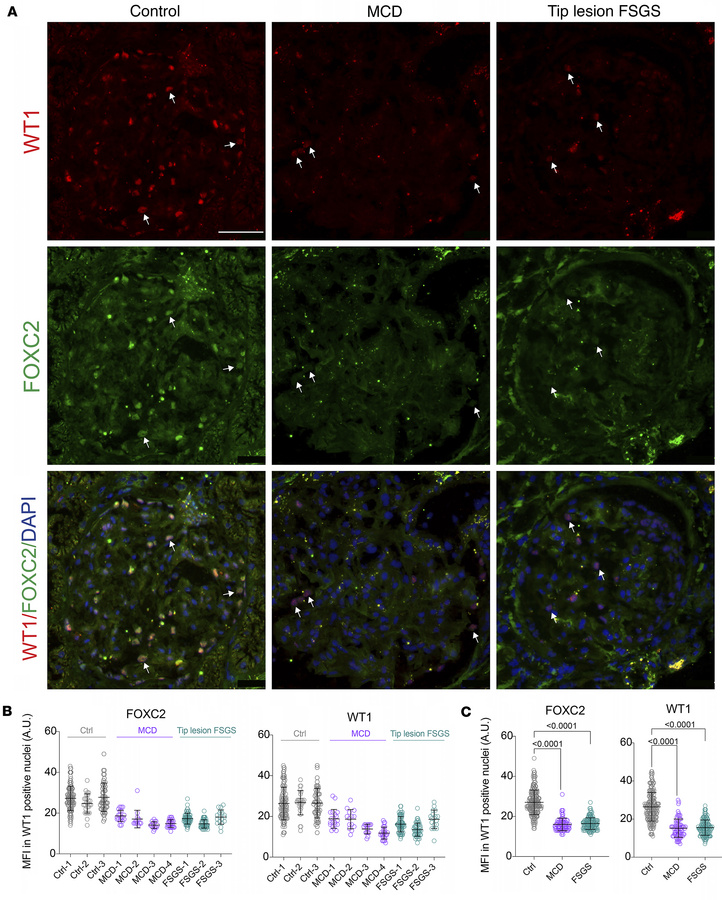 FOXC2 and WT1 in glomeruli of human kidneys.
(A) The protein stained is ...