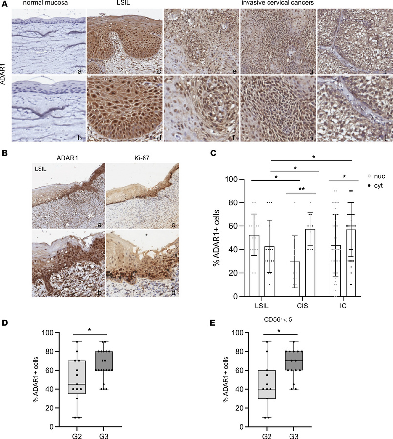 Expression of ADAR1 in normal cervical mucosa, premalignant lesions, and...