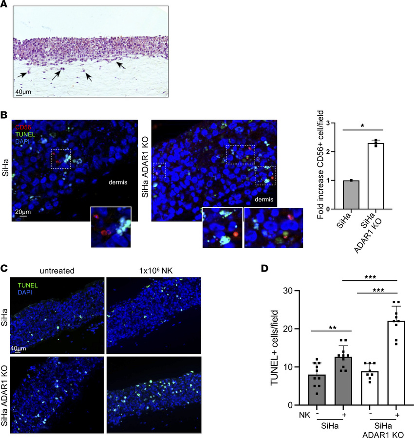 Impact of ADAR1 silencing and of NK cell infiltration on SiHa cell apopt...