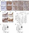 Expression of ADAR1 in normal cervical mucosa, premalignant lesions, and CC