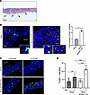 Impact of ADAR1 silencing and of NK cell infiltration on SiHa cell apoptosi