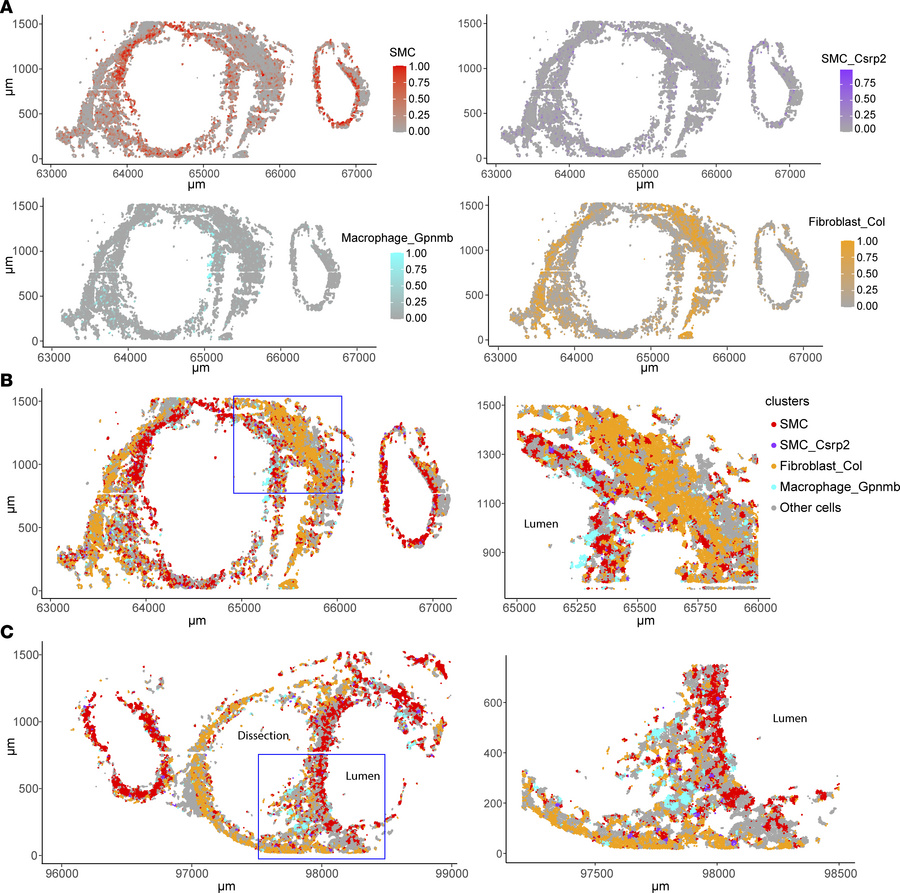 Spatial mapping of macrophages, GPNMB-high macrophages, and SMCs in norm...