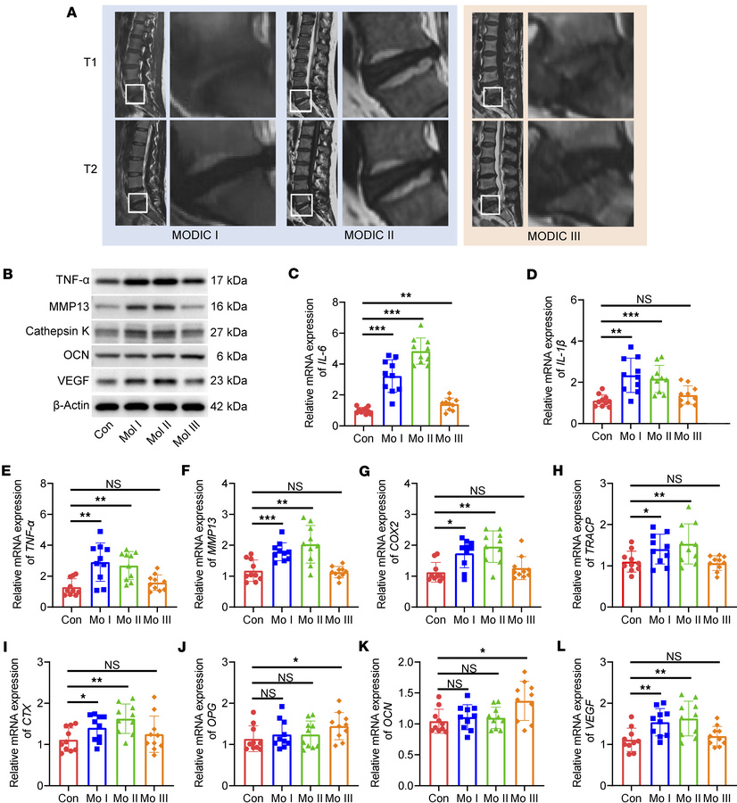 Upregulated expression of bone resorption–associated genes in patients w...