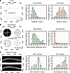 Distribution of functional and structural deficits in patients with monocul