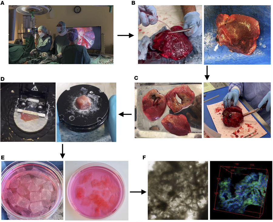 Preparation and culture of TD-PCLS from fresh human lung tumor.
(A and B...