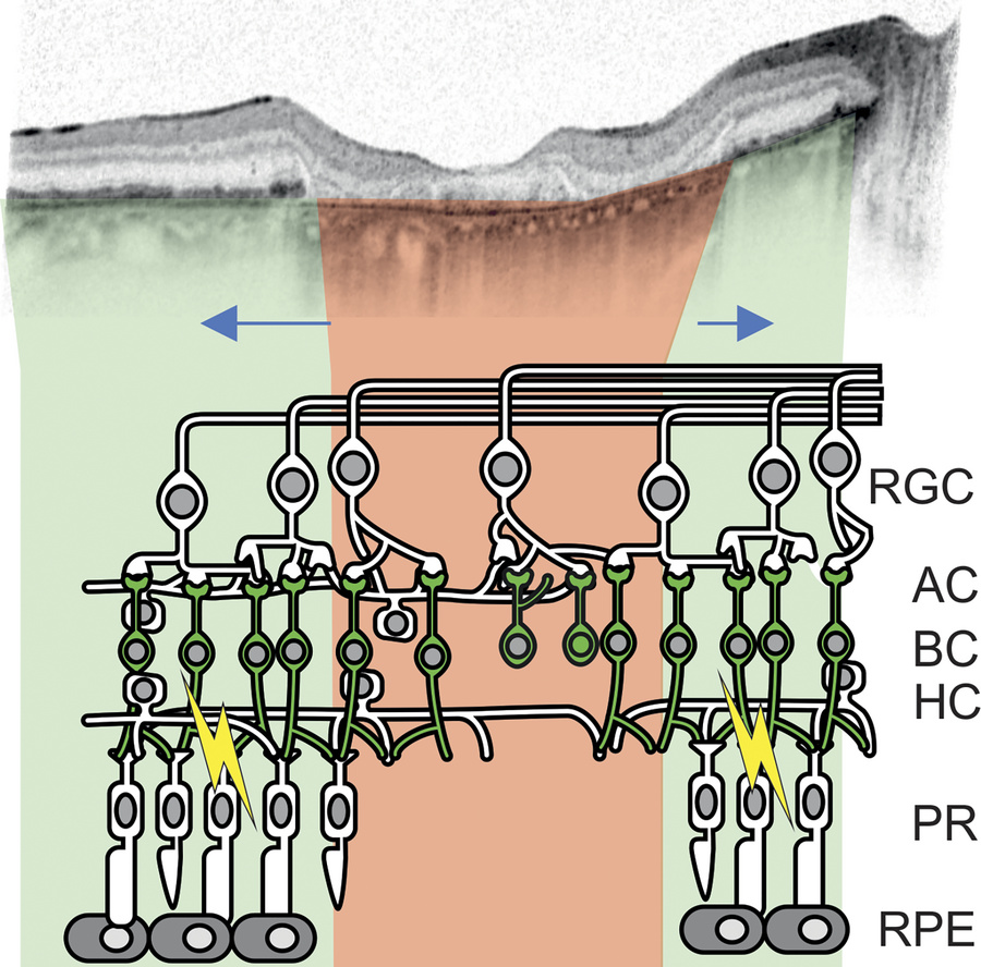 Optogenetic vision restoration in a retina with residual native visual f...