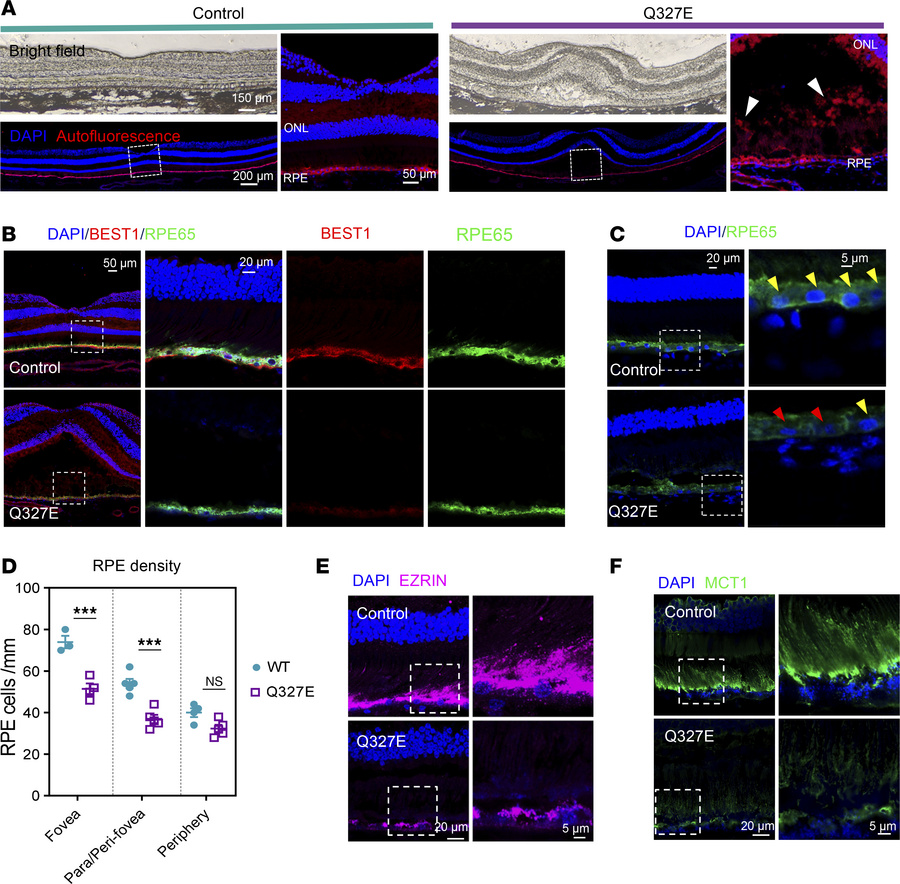 Histopathologic analysis reveals typical pathogenic features of BVMD.
(A...