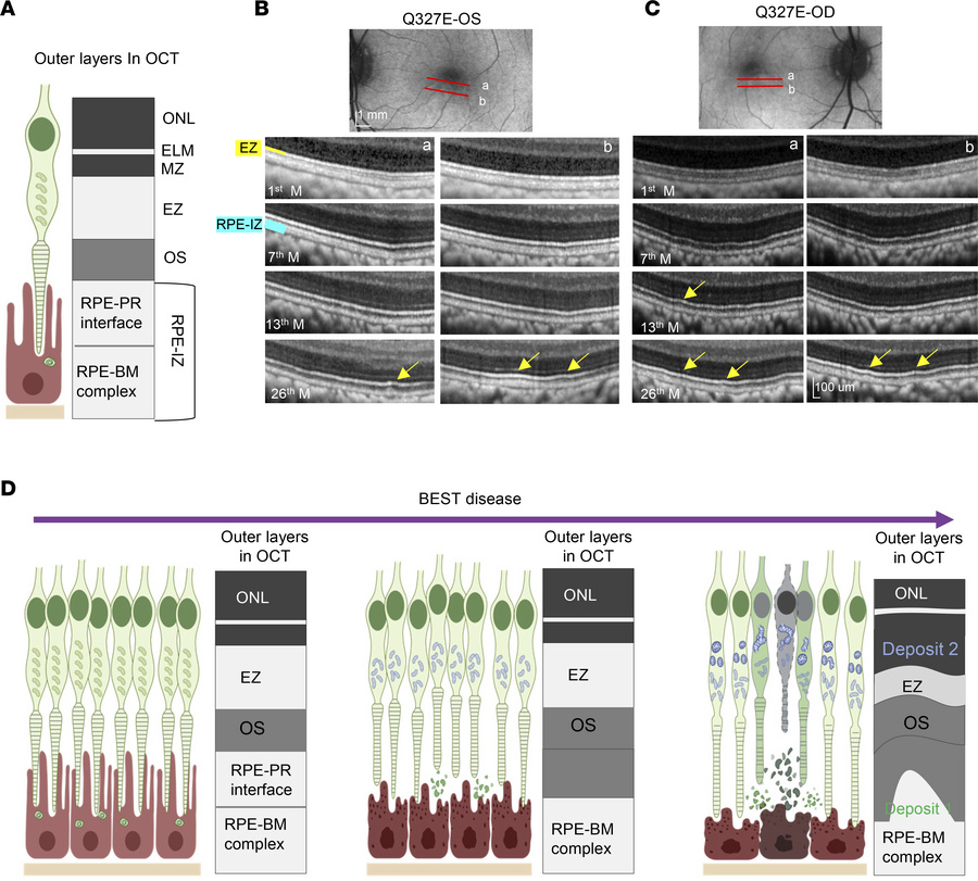 Alteration of outer retinal bands of OCT scans during disease progressio...