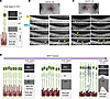 Alteration of outer retinal bands of OCT scans during disease progression i