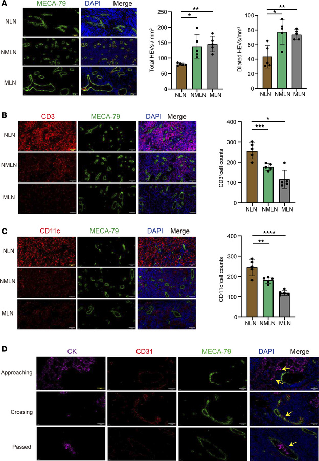 HEV expansion and decreased lymphocyte content in lung cancer lymph node...