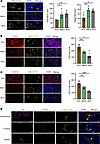 HEV expansion and decreased lymphocyte content in lung cancer lymph node.
