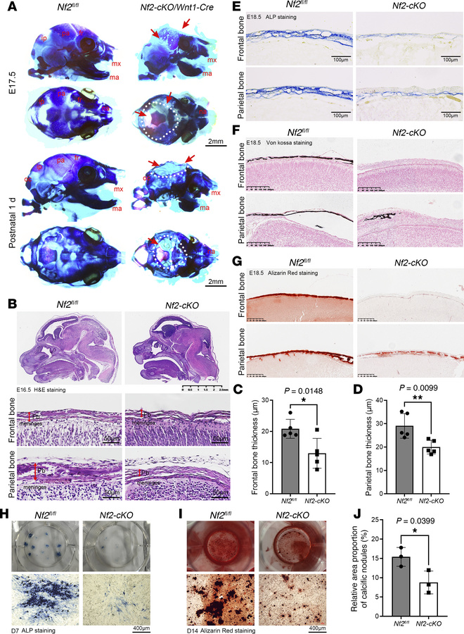 Neural crest–specific Nf2 deletion impairs craniofacial bone development...