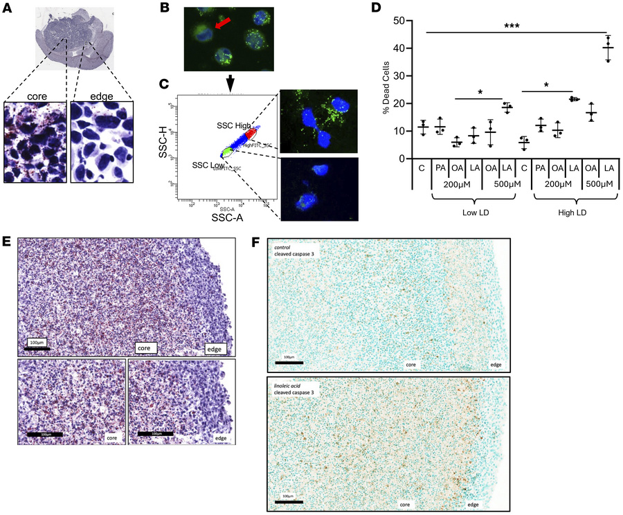 Intratumoral heterogeneity of lipid metabolism in GBM.
(A) Oil Red O sta...