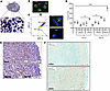 Intratumoral heterogeneity of lipid metabolism in GBM.