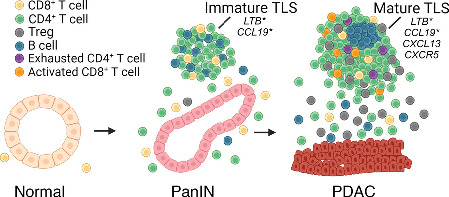 Proposed model of TLS formation from normal to PanIN to PDAC progression...