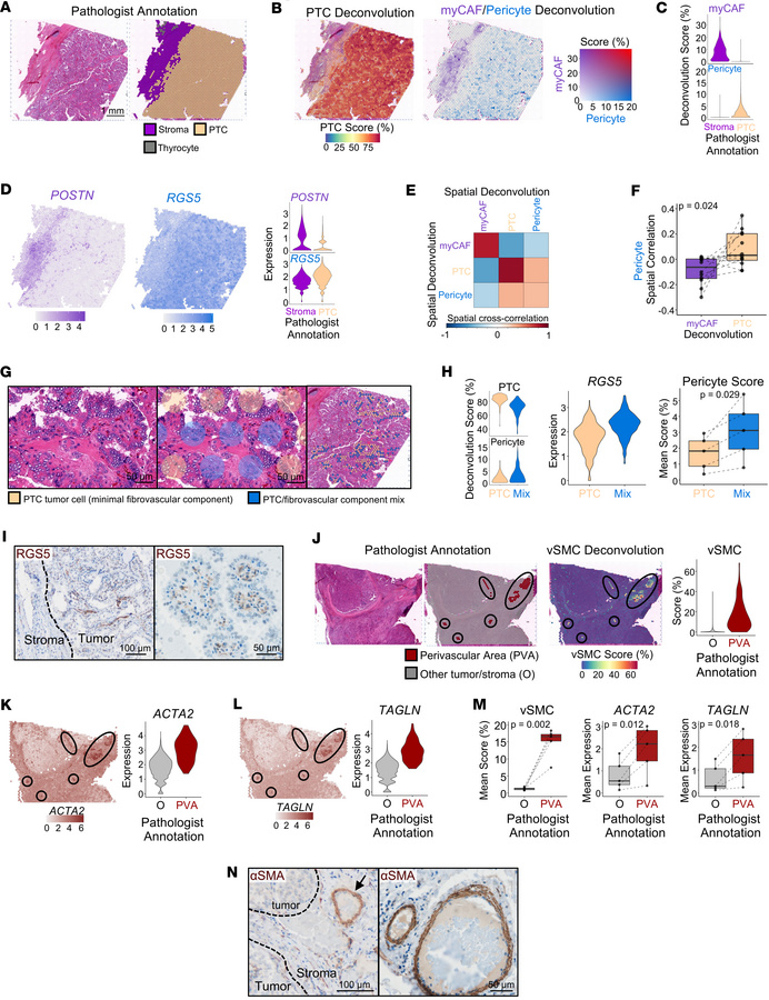 Spatial localization of perivascular populations in thyroid cancer.
(A–E...
