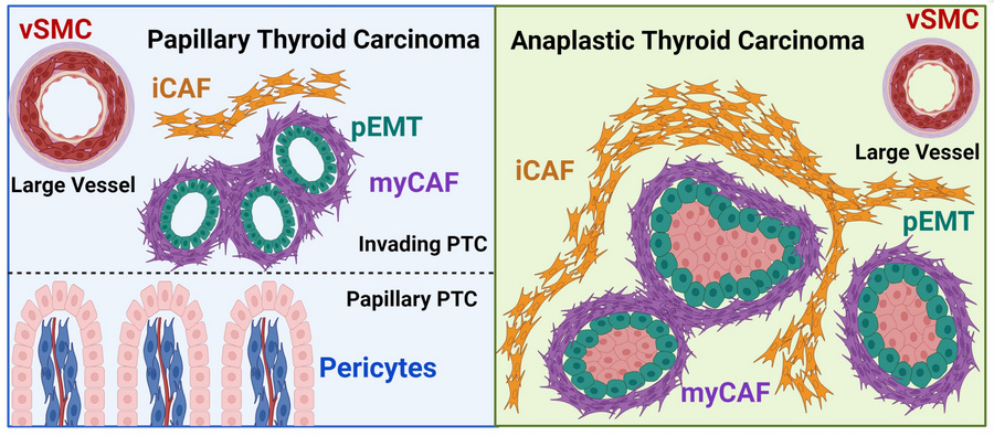 Overview of stromal architecture in thyroid cancer progression.