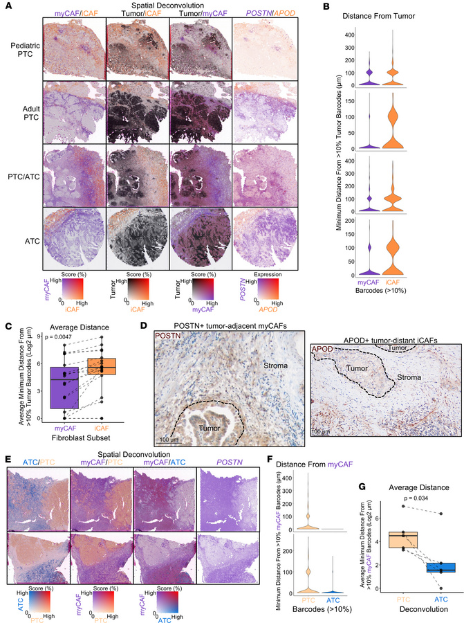 Spatial localization of CAF populations in thyroid cancer progression.
(...