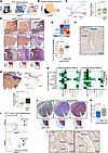Spatial mapping reveals a pEMT phenotype in invasive tumor cells.