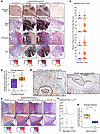 Spatial localization of CAF populations in thyroid cancer progression.