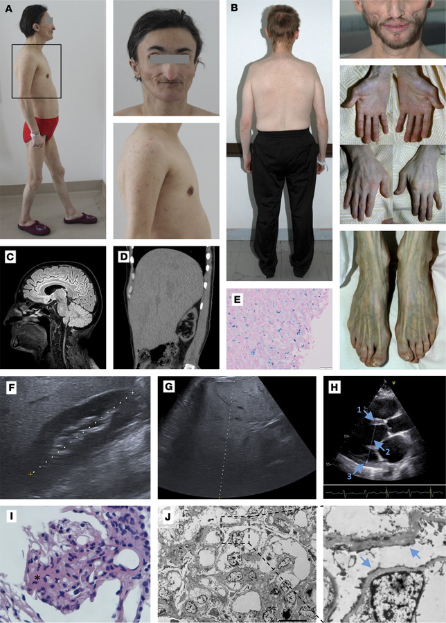 Patients harboring lamin A/C Arg349Trp present with atypical progeroid s...