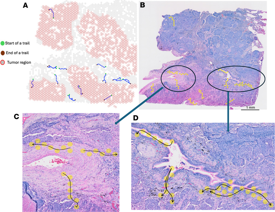 Migration trails identified in a human lung cancer sample and their proj...