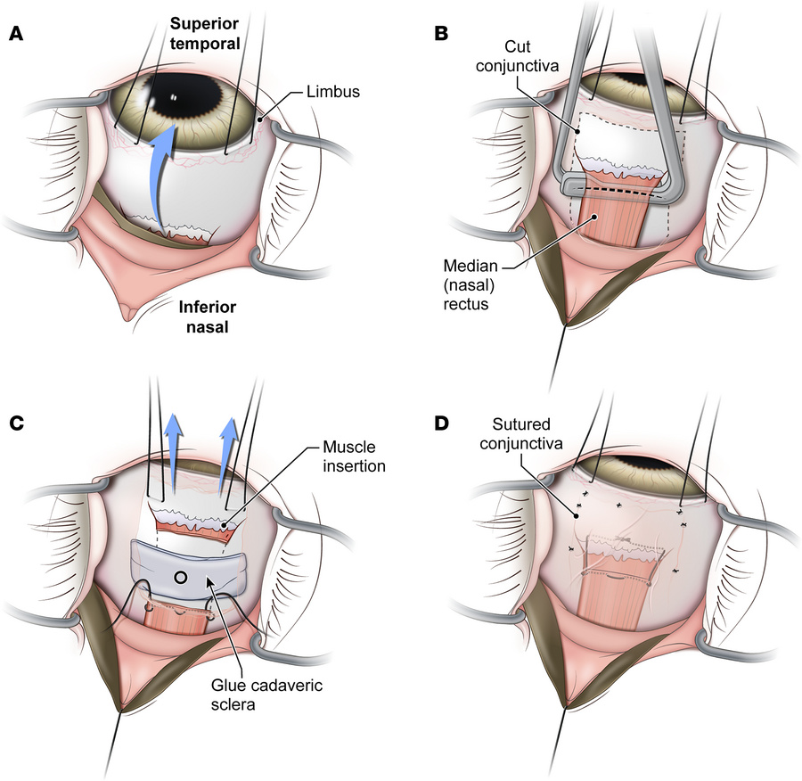 Surgical technique for cadaveric scleral patch placement.
(A) Nasal scle...