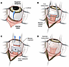 Surgical technique for cadaveric scleral patch placement.