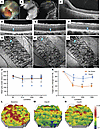 Long-term evaluation of CR injury induced with a cadaveric scleral patch su