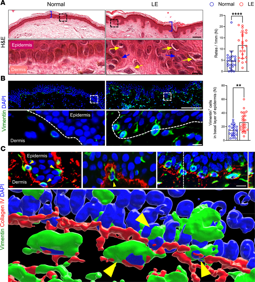 Lymphedema disrupts epidermal architecture and induces vimentin expressi...