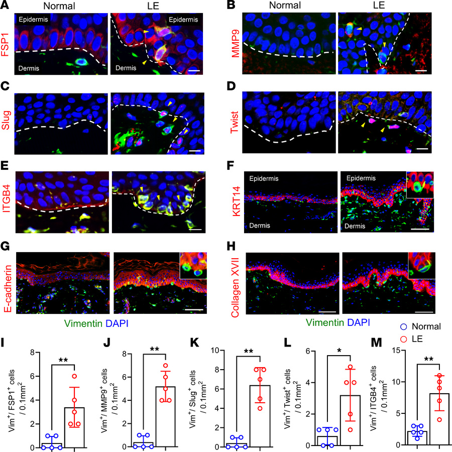 Vimentin+ epithelial cells in lymphedematous skin express EMT genes and ...