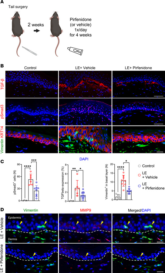 Topical pirfenidone reduces TGF-β signaling and keratinocyte EMT in lymp...