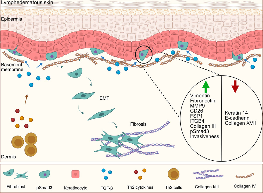 Proposed model of TGF-β–driven keratinocyte EMT and dermal fibrosis in l...