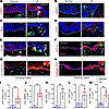 Vimentin+ epithelial cells in lymphedematous skin express EMT genes and los