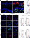 TGF-β signaling drives keratinocyte EMT in lymphedema, both in vivo and in
