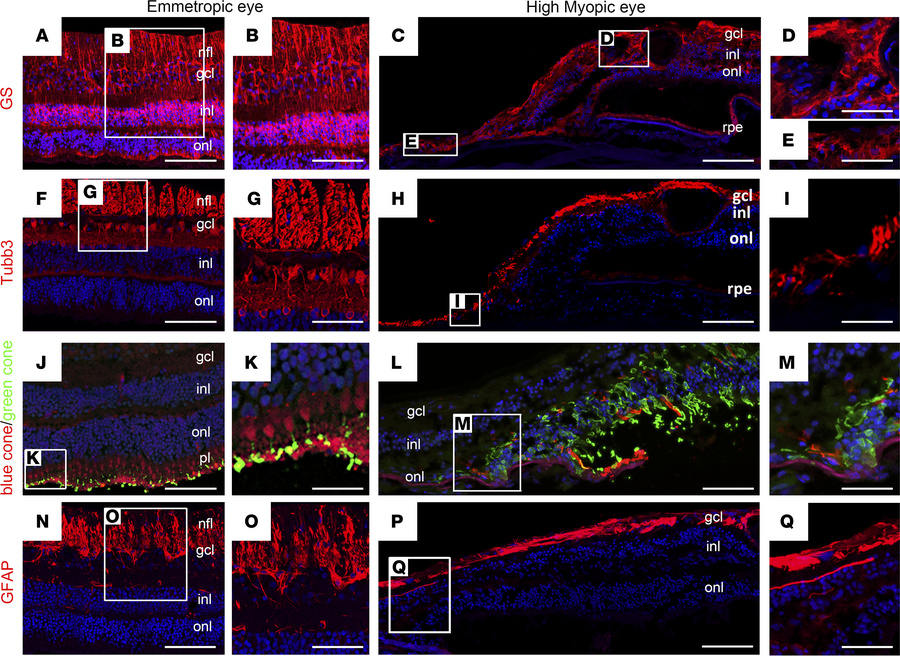 Immunolabeling of retinal cells in the emmetropic and HM retina.
(A and ...