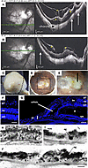 Ophthalmologic imaging and histological analysis of the right eye of an HM