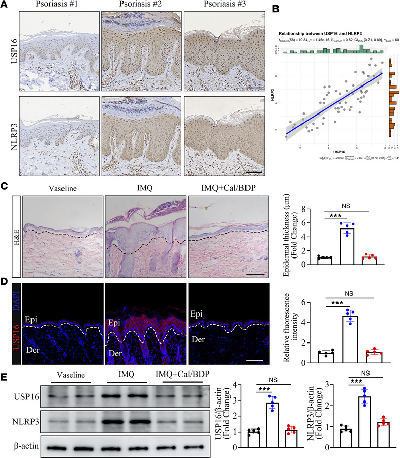 The expression of USP16 in psoriasis has been found to not only correlat...