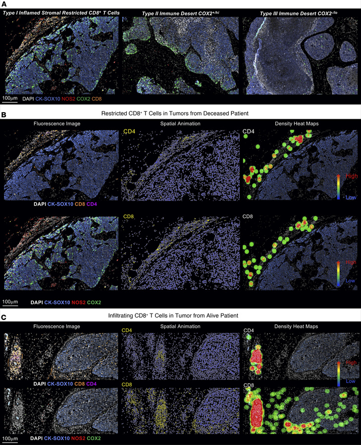 Progression of CD8+ T cell exclusion during the formation of tumor immun...